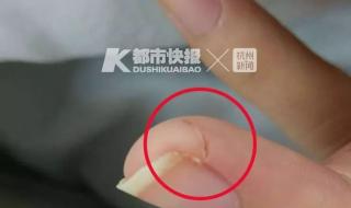 银环蛇咬伤 银环蛇咬伤